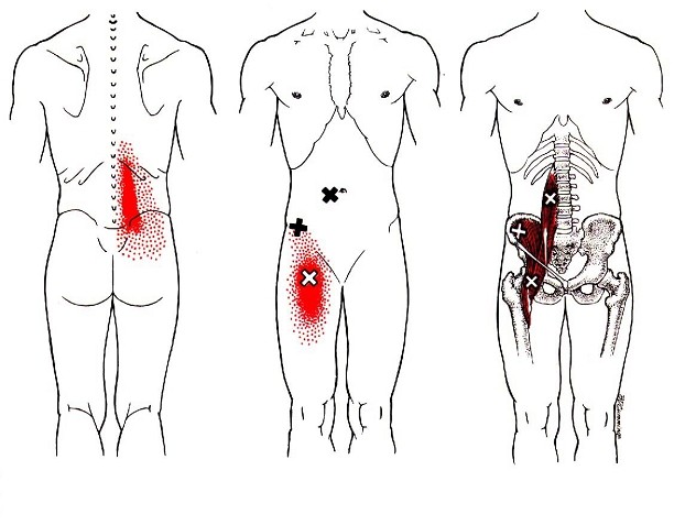 허리 통증을 유발하는 장요근(엉덩허리근)의 트리거포인트(통증유발점)와 마사지법, 스트레칭법, 운동법