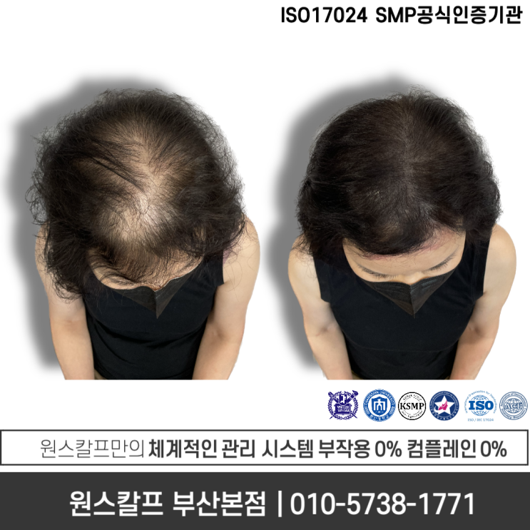  부산두피문신 가격 그리고 견적, 미리 알고가면 좋은것!
