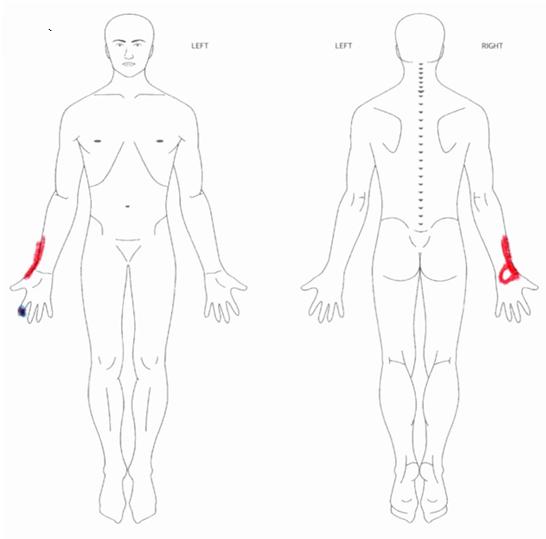  엄지손가락 손목 통증, 손목건초염 원인과 치료