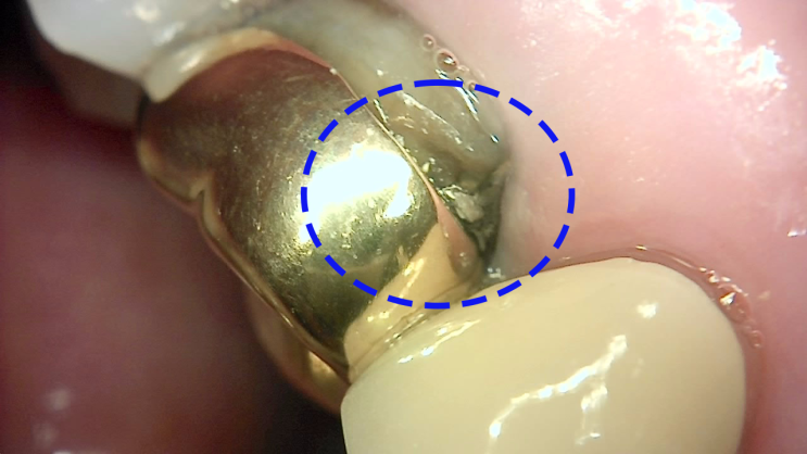 [임상] 충치 & 임플란트(치아가 아파요)