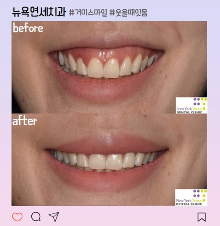  [강남역 치과] 부작용 없는 잇몸 성형 추천 (거미스마일 해결)