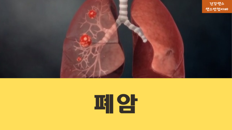  남성 여성 흡연 간접흡연으로 인한 폐암에 대해 알아봐요 : 좋은약초(다시마, 갈취덩굴, 녹차, 부처꽃), 진료과