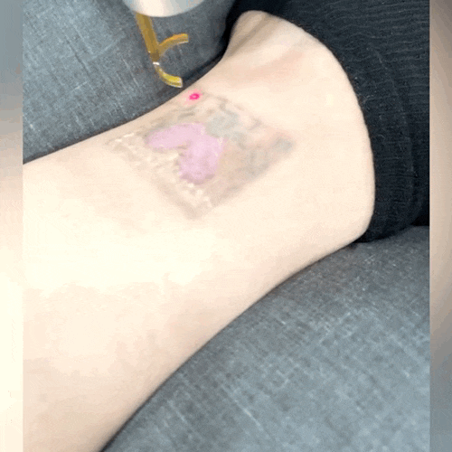 부산 문신제거 깔끔하게 지우고 싶으면? 부산 문신제거 깔끔하게 지우고 싶으면?