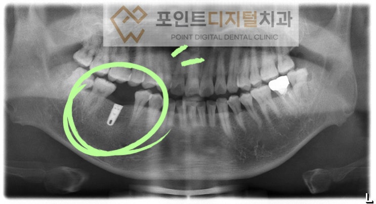  [탕정치과] 임플란트 13년 경과 케이스(짐머 TSV) / 천안 아산