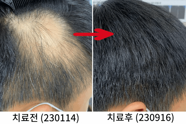  홍대 탈모병원, 여러 부위에 발생한 중증 원형 탈모의 치료사례