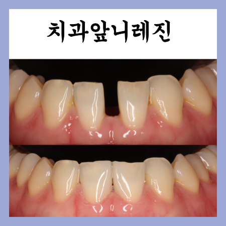  치과레진앞니가격, 앞니 벌어짐을 간단하게 해결