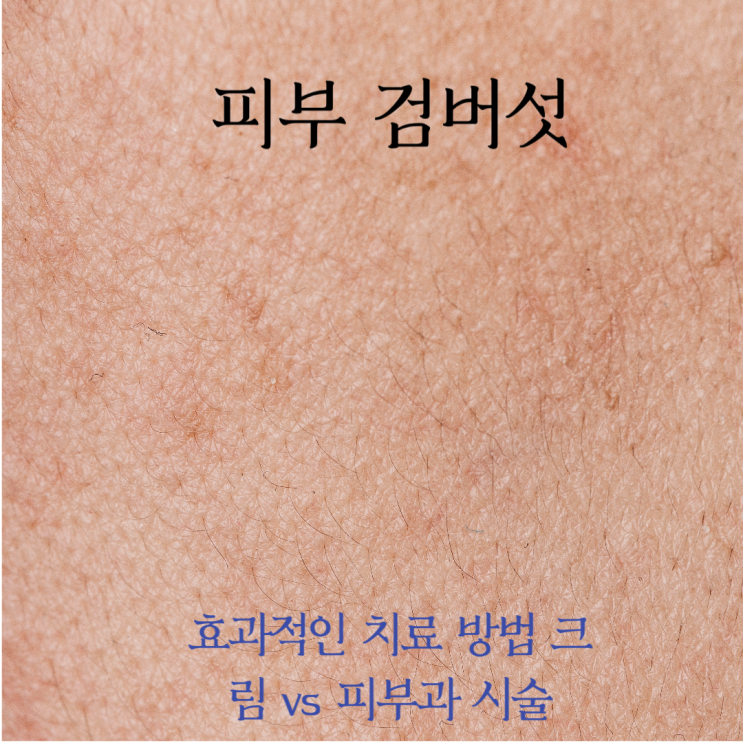  피부 검버섯 효과적인 치료 방법 크림 vs 피부과 시술