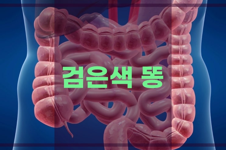  검은색 똥 변을 보는 대장암 조기 발견해야