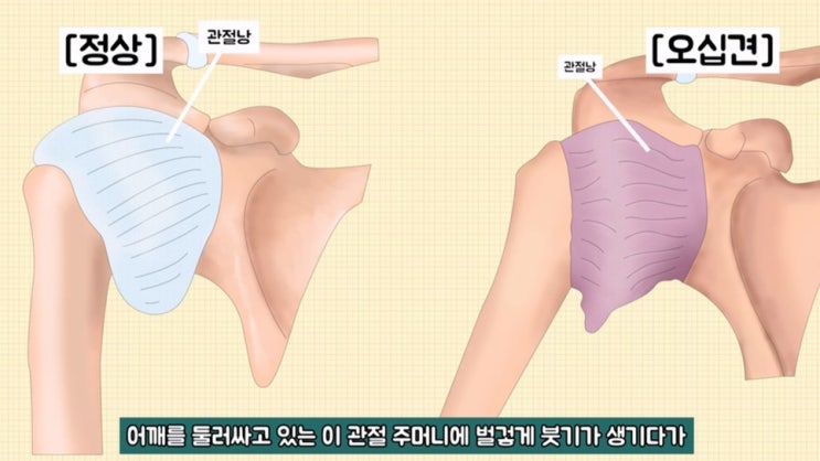  [구로 필라테스] 일상생활을 방해하는 통증 ! 오십견 !!