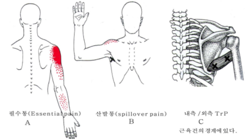 어깨 통증을 유발하는 대원근, 견갑거근의 트리거포인트(통증유발점), 운동법, 스트레칭법