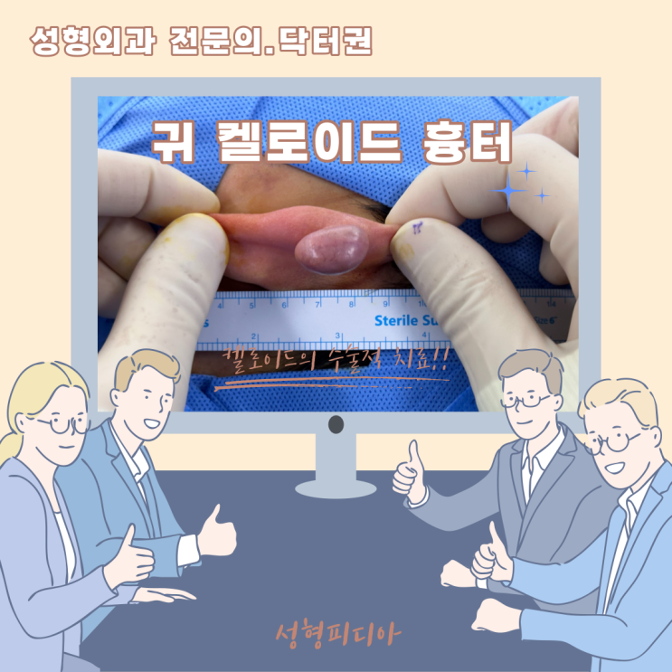  [켈로이드] 귀 켈로이드 수술 치료(후기 사진 포함)는 어떻게하나요? (feat. 성형외과 전문의, 흉터성형술)