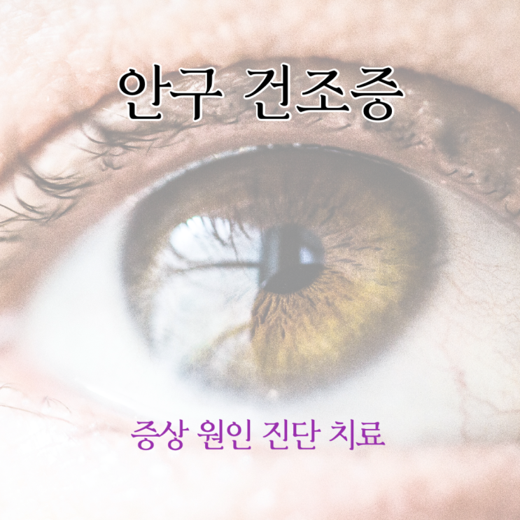  안구 건조증 증상 원인 진단 치료