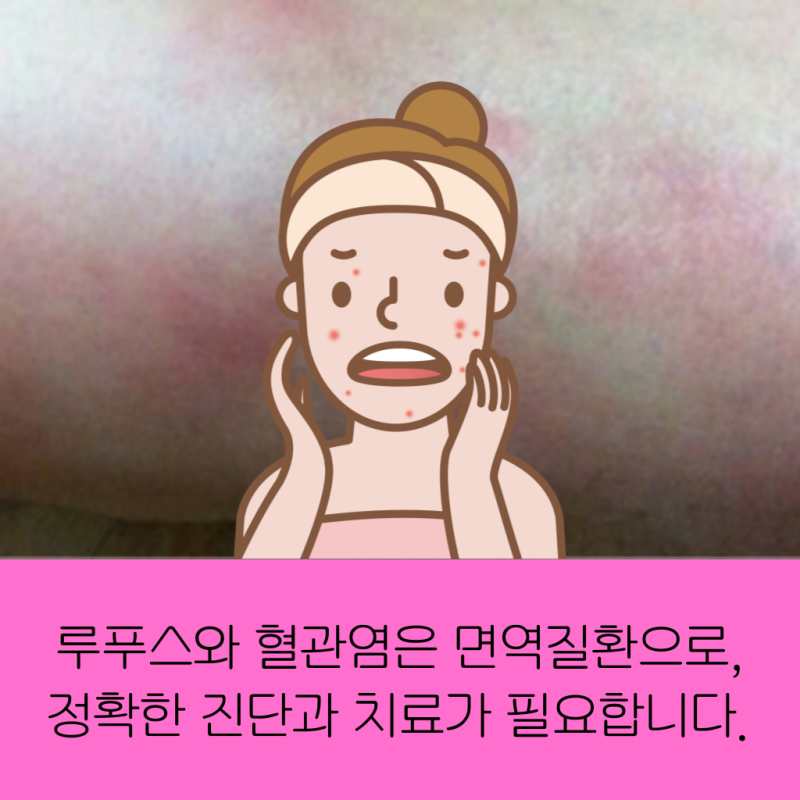 루푸스 혈관염 질환 치료 중점 류마티스내과 [대전 류마내과의원]