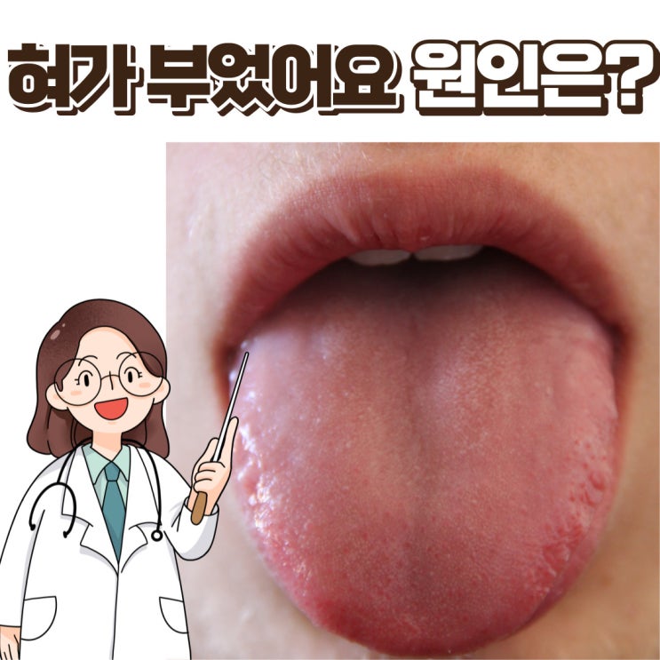  혀가 부었어요 얼얼해요, 혀붓기 원인 치료 방법은?