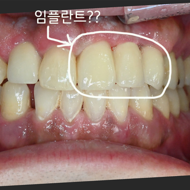 앞니(전치부) 임플란트 치료 / 금광동 치과 이숲치과
