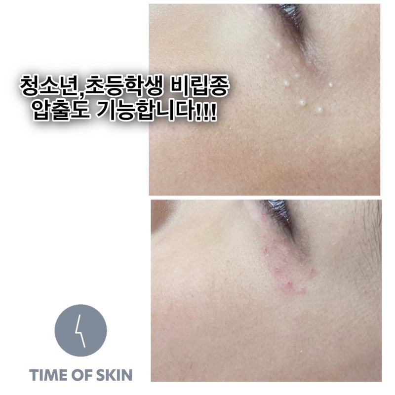 파주학생비립종압출 - 고민하지 말고 상담받아보세요!