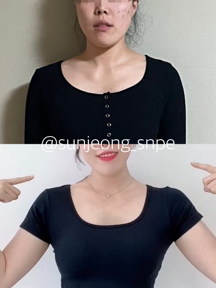  [대구SNPE 리셋바디] 오직 SNPE로만 변화된 어깨라인 비포&에프터 / 어깨라인 / 대구라운드숄더 / 대구거북목