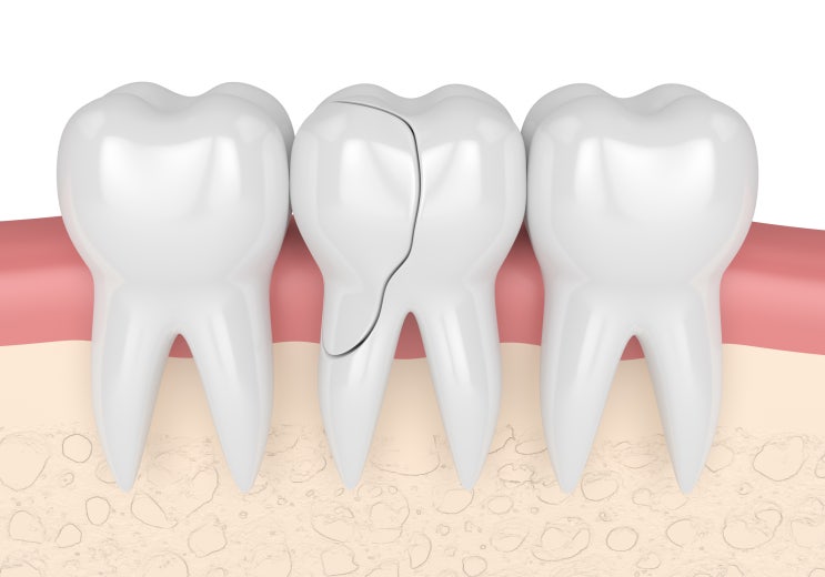 강남역 충치, 씹을 때 치아가 시큰하다면 치아 크랙 증상?