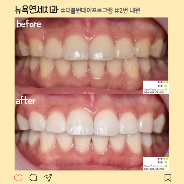 [강남역 치과] 당일 완성 원데이 치아미백 만족스러운 효과 솔직 후기