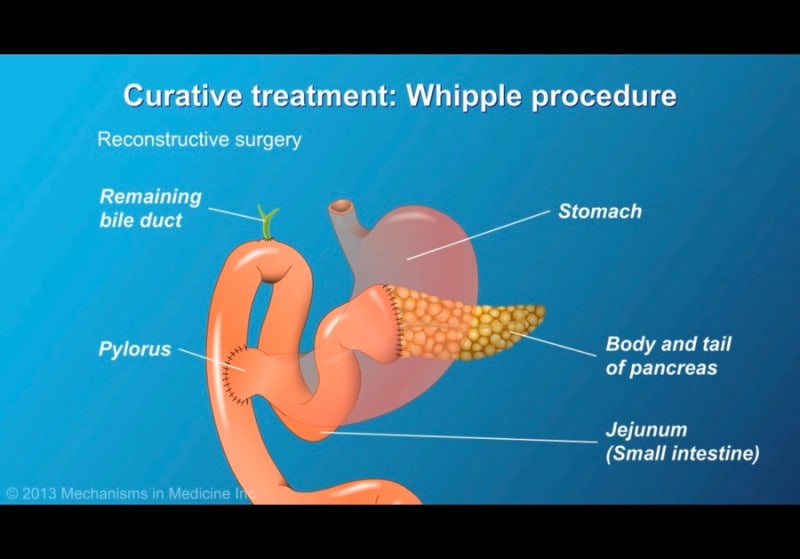 휘플 whipples procedure (PPPD) 췌장암 수술 공부하기 : 네이버 블로그
