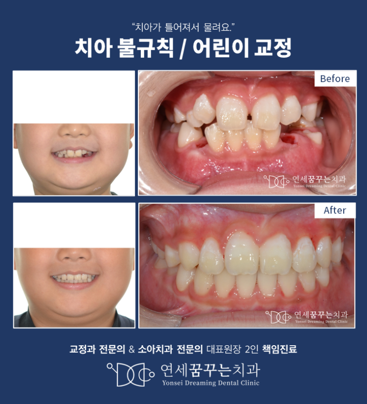 어린이 부정교합, 치아 불규칙을 해결하게 되면 미소가 달라진다? 어린이 부정교합, 치아 불규칙을 해결하게 되면 미소가 달라진다?