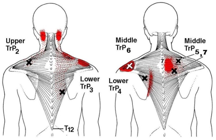목, 어깨 통증을 유발하는 승모근(등세모근)의 트리거포인트(통증유발점)