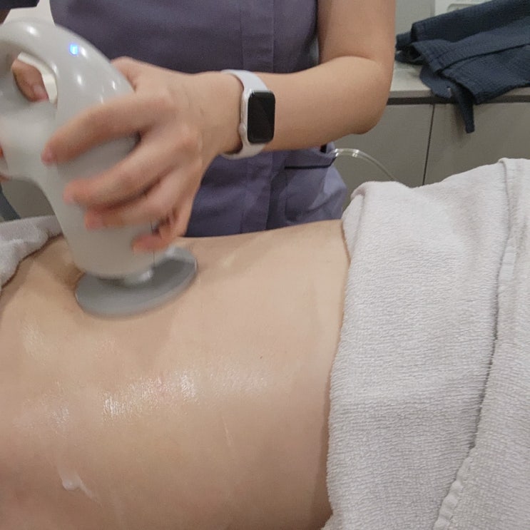  수술없이 뱃살제거하는 다이어트시술 복부 셀룰리스 1회차