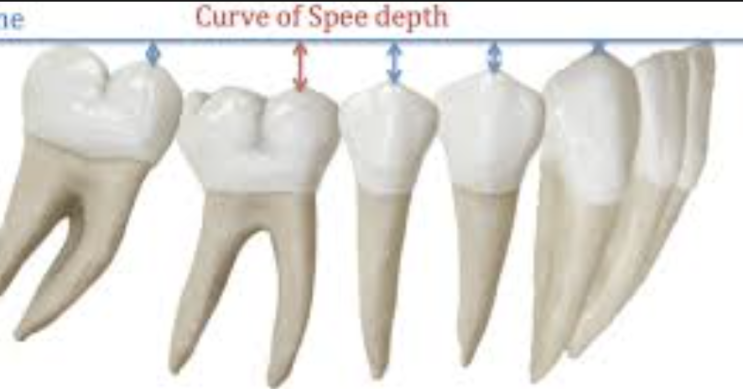치아교정 레벨링이란 뭐에요? 교정의 첫 단계 - 치아 높낮이 맞추기 : 압하, 정출