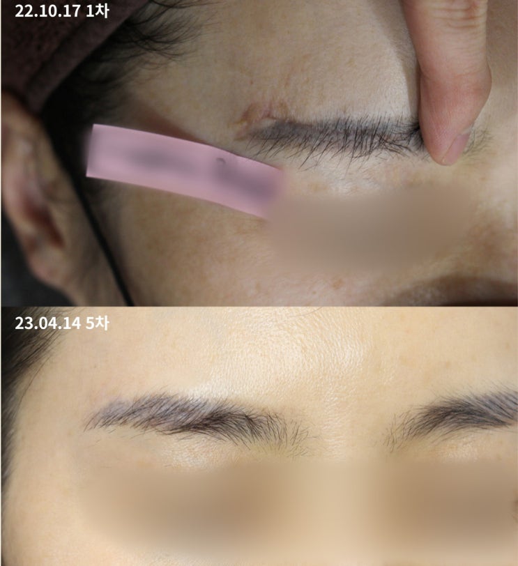 부산 흉터제거 30번 치료해도 소용없는 이유 부산 흉터제거 30번 치료해도 소용없는 이유