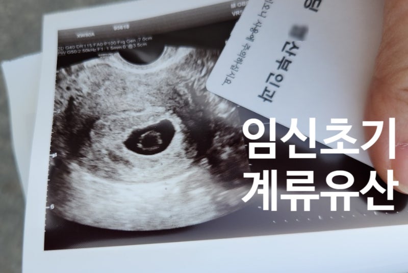 임신 초기 계류유산 전조증상 확률 알아보기, 소파술 후기