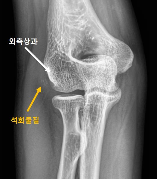  외측상과염 수술? 치료해도 재발하는 팔꿈치 통증