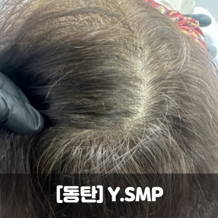 동탄 Y.SMP 여자 정수리탈모 솔직후기 2~3회차