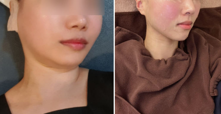 서울 보톡스, 피부과 대표원장이 직접 얘기하는 부위별 보톡스