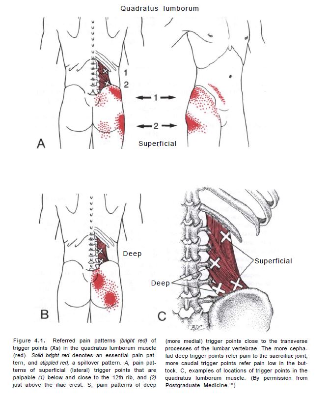 허리 통증을 유발하는 요방형근(허리네모근)의 트리거포인트(통증유발점)