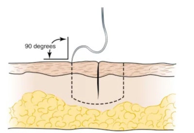 OSCE, 국시 상처봉합(simple suture) 노하우 - 영상자료 : 네이버 블로그