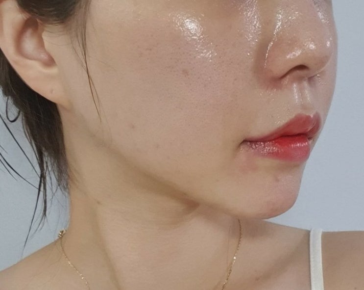  내성없는 사각턱보톡스 코어톡스 찐후기