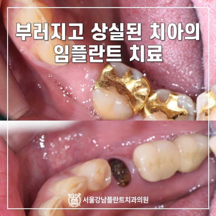 부러지고, 상실된 치아의 임플란트 치료 (feat. 통증이 없더라도..)