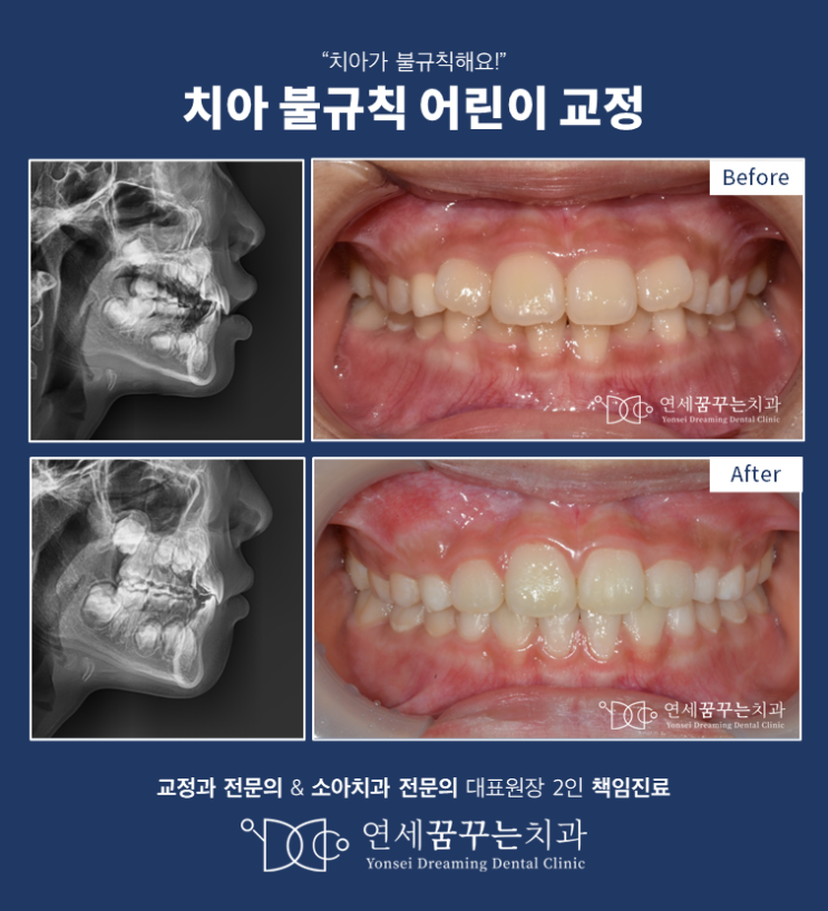 치아가 틀어짐과 부정교합을 함께 잡아주는 어린이 교정, 하남 어린이 교정은?