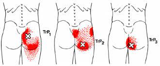 허리, 골반 통증을 유발하는 대둔근(큰볼기근)의 트리거포인트(통증유발점), 복근과 대둔근, 엉덩이 운동, 엉덩이의 인기 비결, 상체와 엉덩이