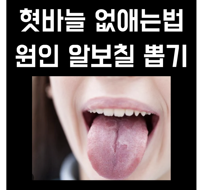 혓바늘 없애는법 원인 약 알보칠 뽑기