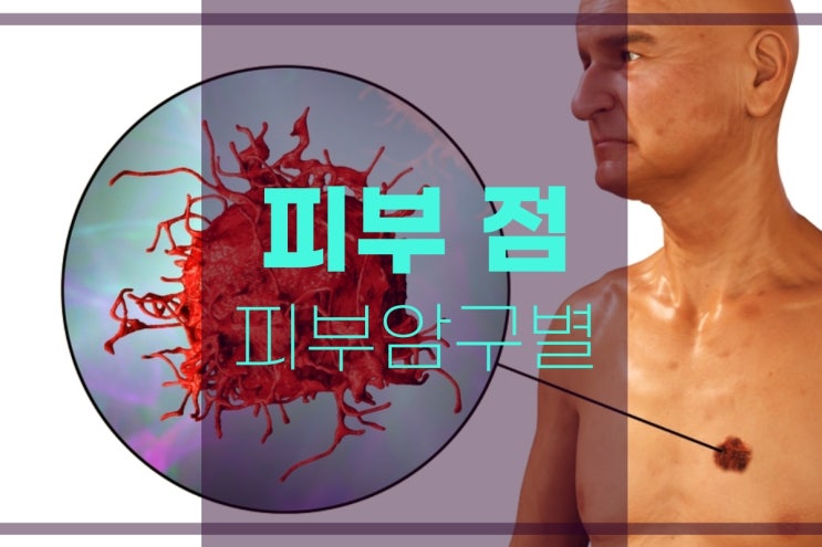  피부에 점, 크기가 커지는 피부암 구별하기