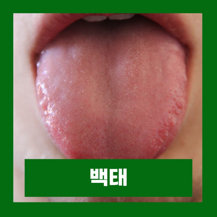  백태 없애는법 입냄새 원인 혀 백태제거
