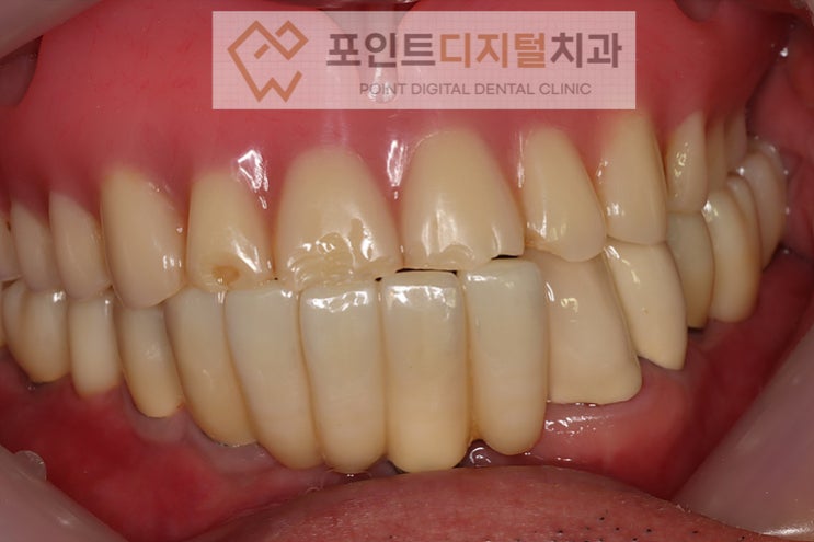  [탕정임플란트] 서지컬 가이드(네비게이션) 비용은 무료입니다 / 천안 아산