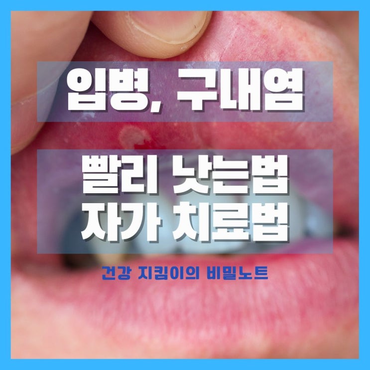  입병, 구내염 빨리 낫는법을 알아보자