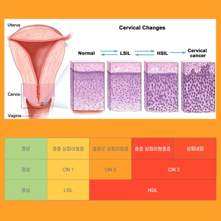  자궁경부 이형성증 1단계 CIN1 LSIL