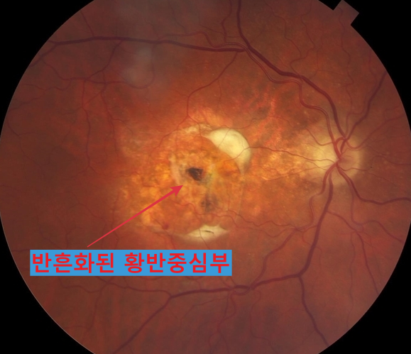  황반변성 당뇨망막병증 주사 저도 보험으로 맞을 수 있나요? 보험기준 정리+ 황반변성 산정특례 기준 알아보기 [강동구 천호역 천호동 암사동 풍납동 그랜드성모안과]
