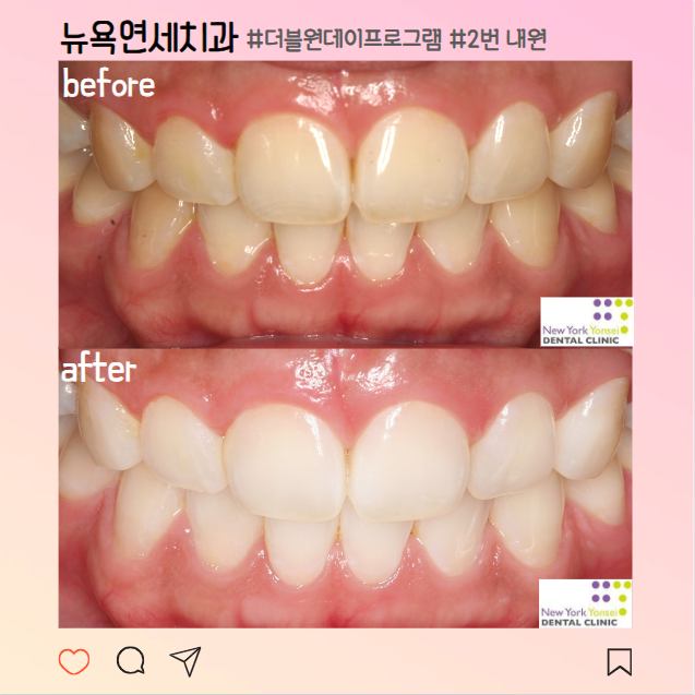 [강남역 치과] 치과 치아미백 비용과 원데이 치아미백 효과/후기