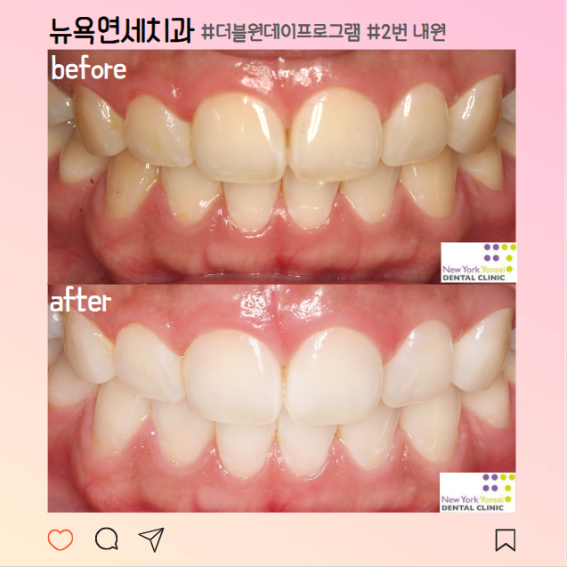  [강남역 치과] 치과 치아미백 비용과 원데이 치아미백 효과/후기