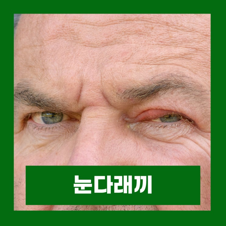  눈다래끼 종류별 증상 원인 전염 찜질 치료