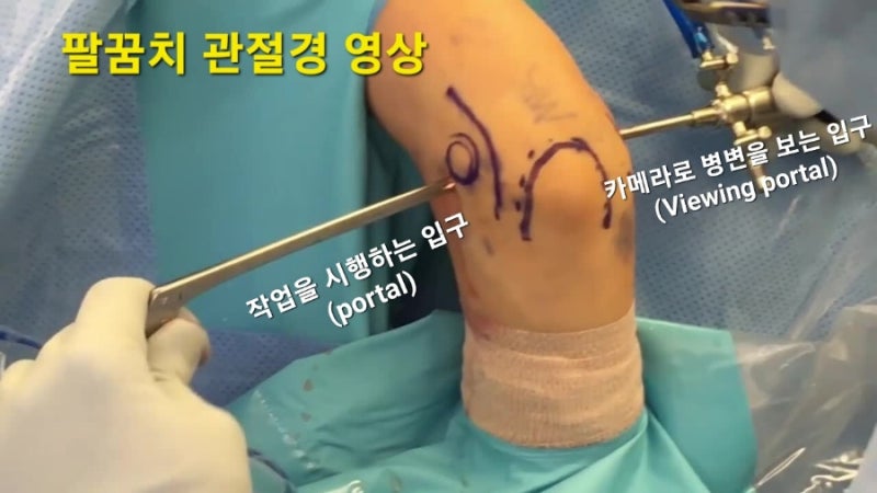 팔꿈치에 발생한 테니스 엘보 (Tennis elbow) 크게 열어서 수술하지 마세요. 관절경으로 빠르고 ....